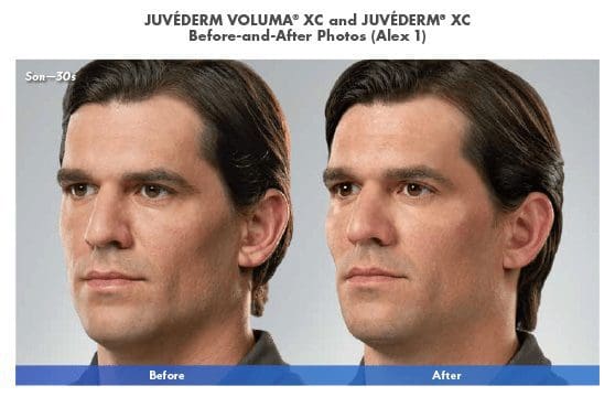 Blue Halo Med Spa - Injectable Artistry - Juvederm2