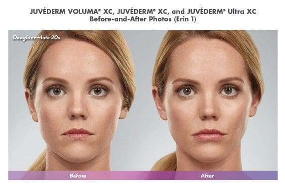 Blue Halo Med Spa - Injectable Artistry - Juvederm4