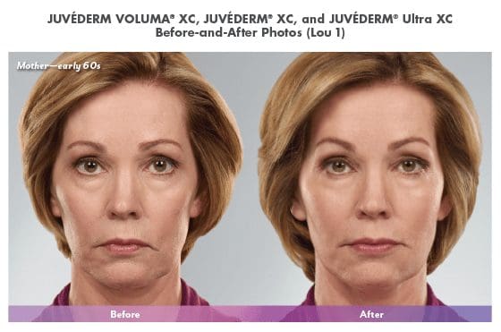 lue Halo Med Spa - Injectable Artistry - Juvederm5