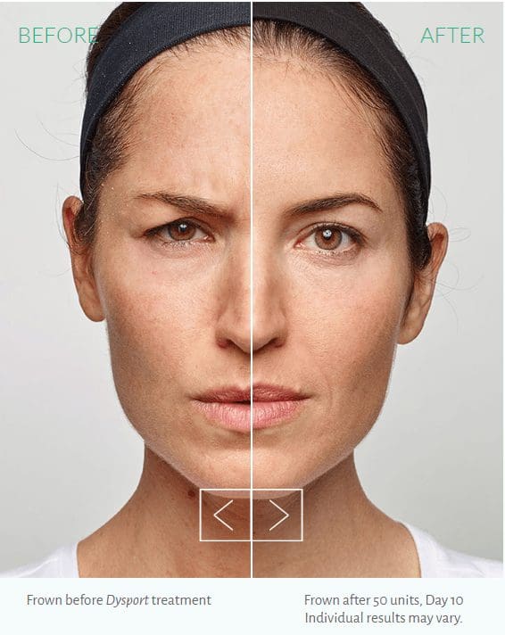 Blue Halo Med Spa - Injectable Artistry - dysport