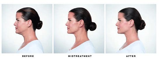 Blue Halo Med Spa - Injectable Artistry - kybella1