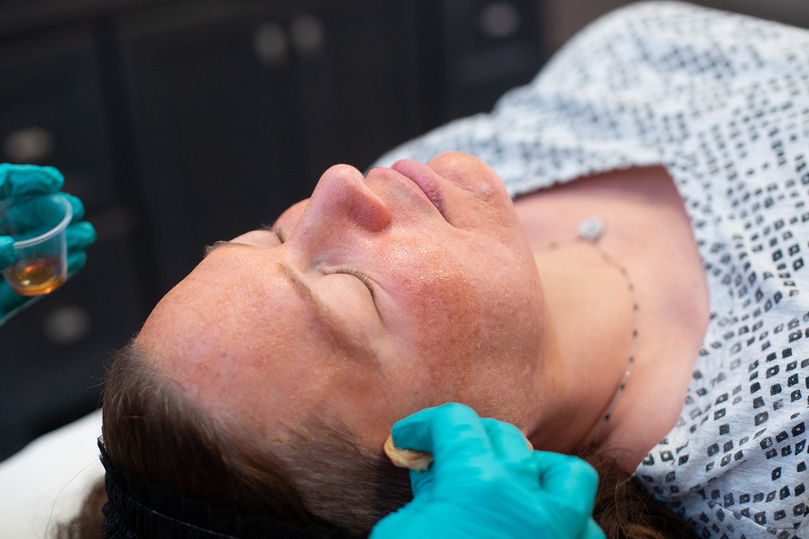 Rejuvenate the Skin You're In With a Chemical Peel - Dontage