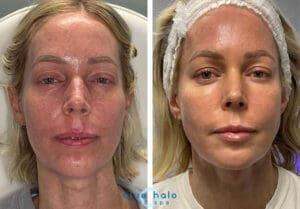 Sculptra Before and After