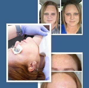 BBL Photofacials Sundamage Improvements